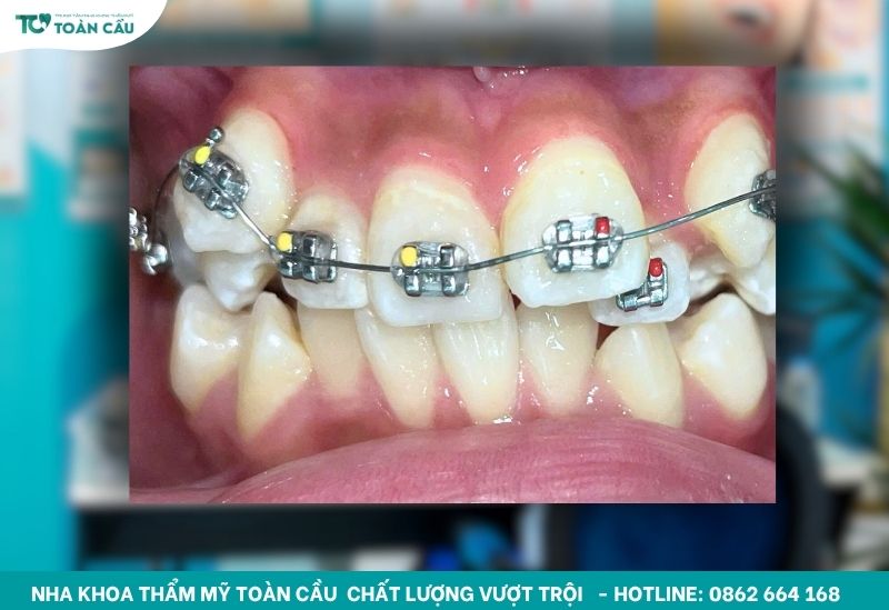 Niềng để chỉnh răng mọc lệch ở TPHCM bao nhiêu tiền? 5 Răng mọc lệch