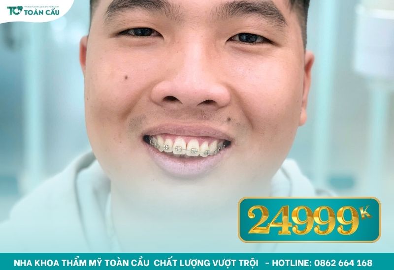 Niềng để chỉnh răng mọc lệch ở TPHCM bao nhiêu tiền? 9 Niềng răng mắc cài kim loại 24.999.000 VNĐ