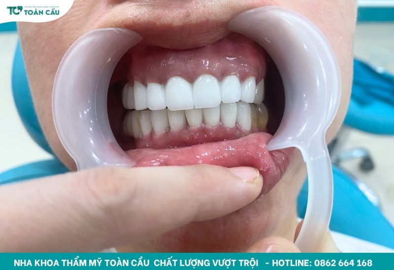 Cercon HT - Dòng răng thanh lịch chuẩn Đức
