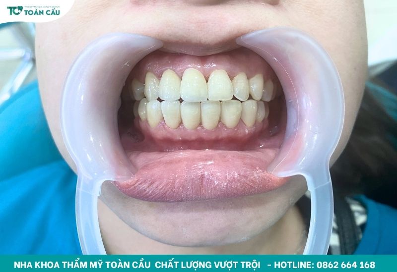 Răng sứ cao cấp Zirconia