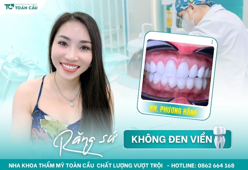 Răng sứ không đen viền