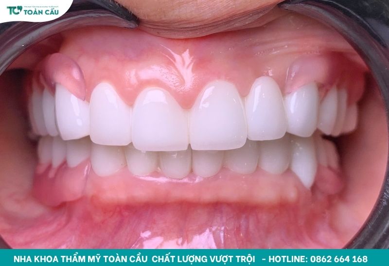 Nha khoa làm răng sứ thẩm mỹ đẹp tự nhiên tại TPHCM 6 Răng có độ trong suốt hợp lý