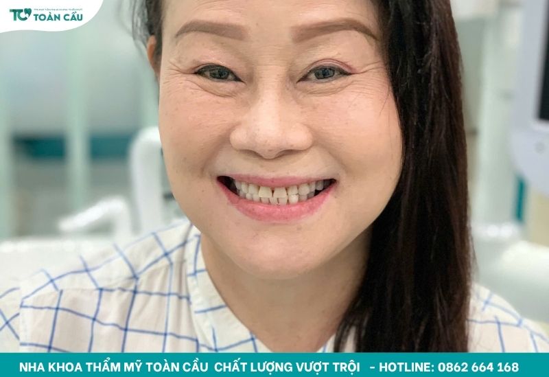 Tẩy trắng răng không ê buốt, hiệu quả tại nha khoa uy tín 5 Nỗi lo ê buốt khi tẩy trắng răng