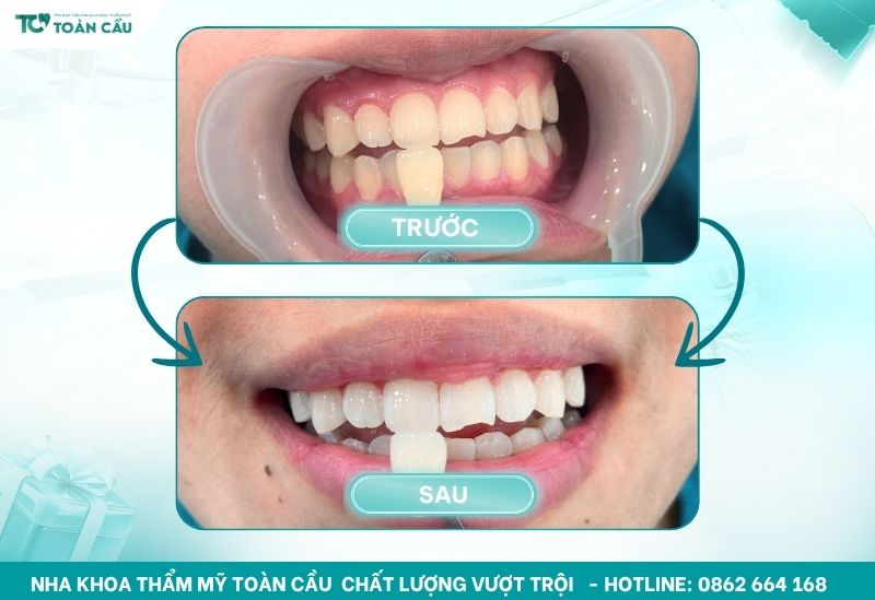 Tẩy trắng răng không ê buốt, hiệu quả tại nha khoa uy tín 9 Hiệu quả tẩy trắng răng tại Toàn Cầu