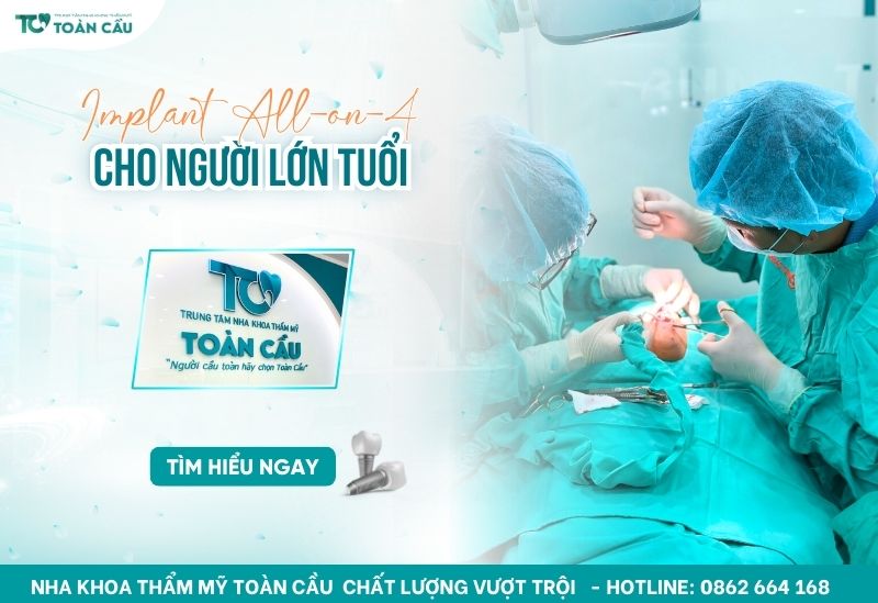 Trồng răng toàn hàm bằng phương pháp All on 4