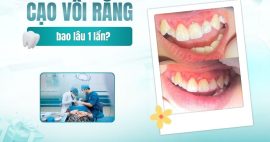 bao lâu nên cạo vôi răng