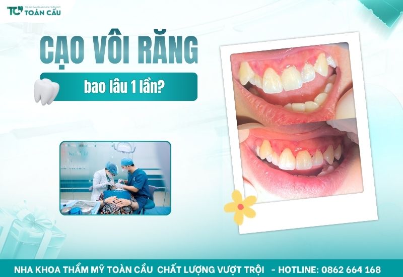 bao lâu nên cạo vôi răng