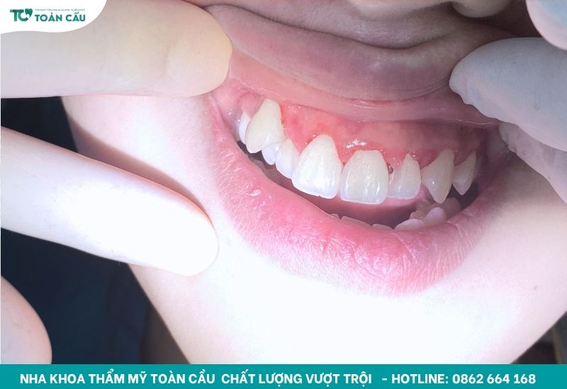 Bao lâu nên cạo vôi răng 1 lần là tốt nhất? 6 Cạo vôi giúp răng sạch sẽ và thông thoáng