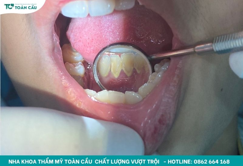 Bao lâu nên cạo vôi răng 1 lần là tốt nhất? 8 Dịch vụ lấy cao răng Gò Vấp an toàn