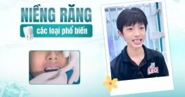 Các loại niềng răng