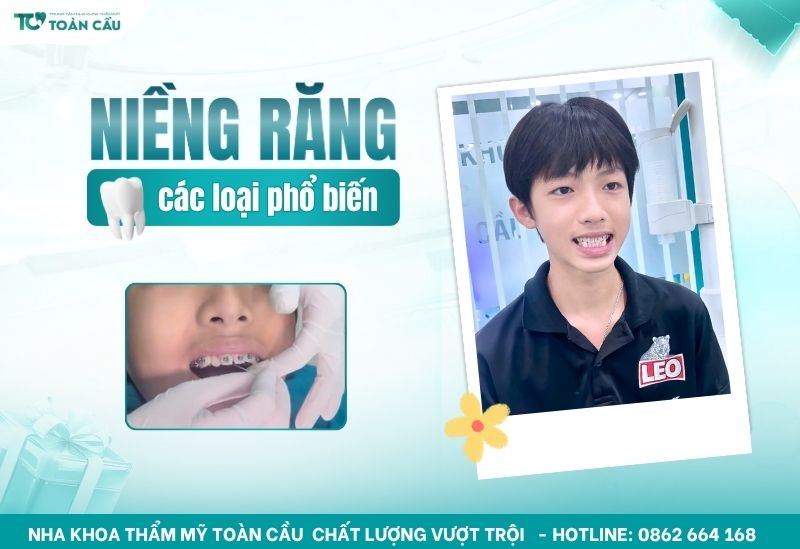 Các loại niềng răng