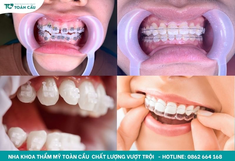 Các loại niềng răng phổ biến hiện nay kèm giá chi tiết 5 Các loại niềng răng phổ biến hiện nay
