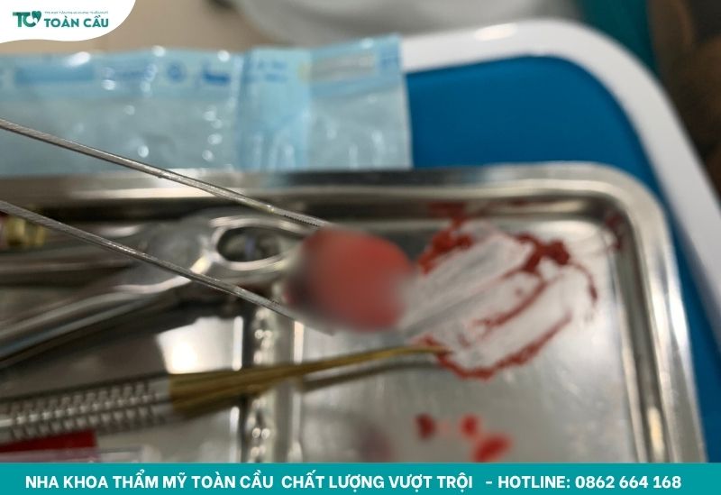 Các loại niềng răng phổ biến hiện nay kèm giá chi tiết 6 Nhổ răng để tạo khoảng trống phù hợp