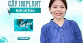 Cấy ghép implant khi bị mất 1 răng