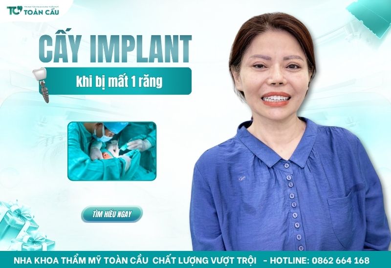 Cấy ghép implant khi bị mất 1 răng