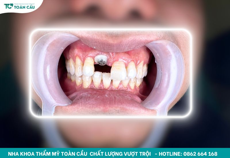 Quy trình cấy ghép implant khi bị mất 1 răng chi tiết 9 Cấy ghép implant khi bị mất 1 răng