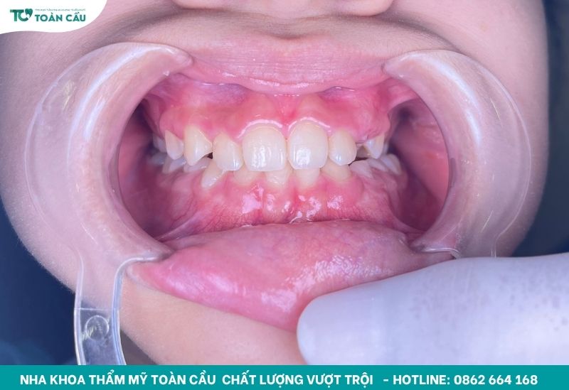 Chi phí niềng răng hô nhẹ cập nhật mới nhất hiện nay 5 Răng hô nhẹ vẫn cần niềng