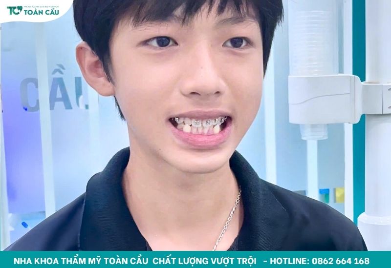 Chi phí niềng răng hô nhẹ cập nhật mới nhất hiện nay 6 Mắc cài kim loại là phương pháp niềng phổ biến