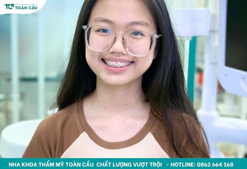 Chỉnh nha cho học sinh giá tốt, trọn gói tại HCM 5 Chỉnh nha sớm cho học sinh