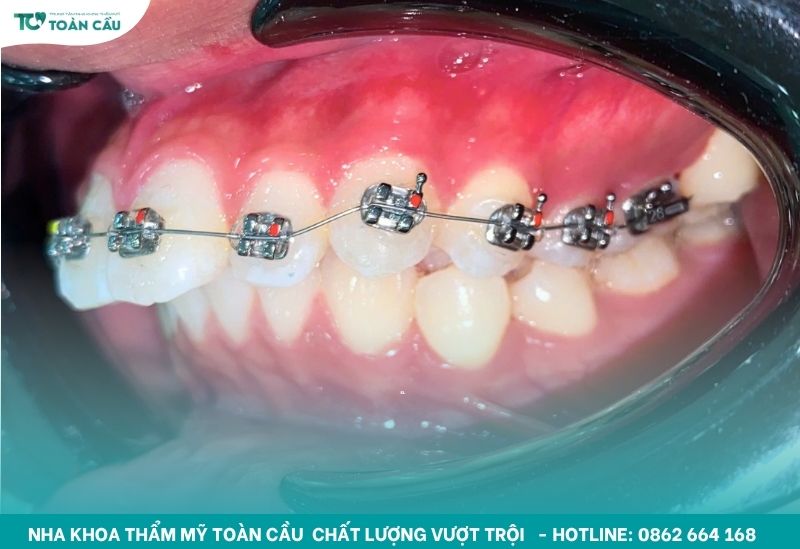 Áp lực tác động liên tục lên răng theo thời gian