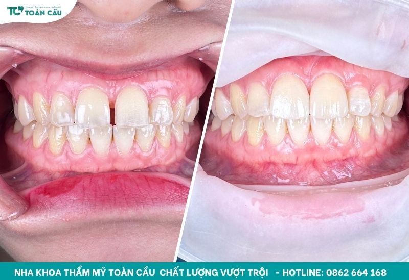 Dán veneer răng cửa thưa cùng Toàn Cầu