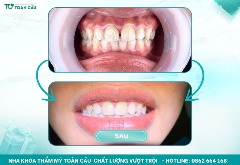 Kết quả dán sứ veneer thẩm mỹ gần đây