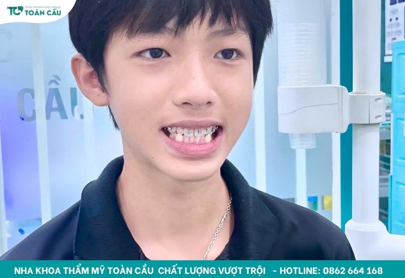 Địa chỉ chỉnh nha trẻ em giá rẻ, uy tín TPHCM ba mẹ nên biết 5 Niềng răng trẻ em