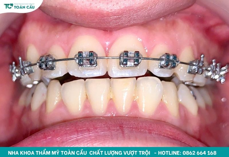 Giá niềng răng là bao nhiêu? Cập nhật bảng giá kèm ưu đãi 8 Nha khoa niềng răng giá rẻ uy tín