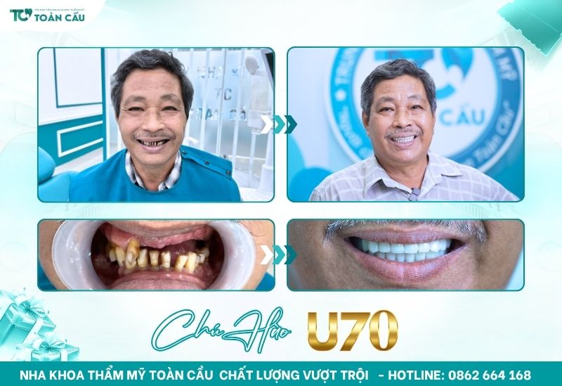 Khách hàng cấy implant toàn hàm