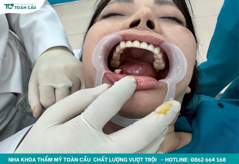 Sự lựa chọn tối ưu cho người lớn tuổi mất răng toàn hàm