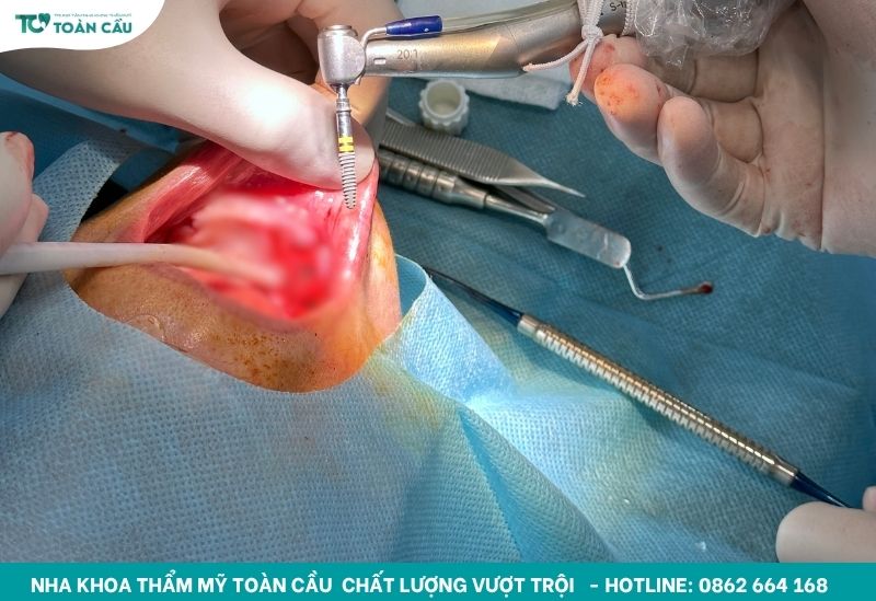 Địa chỉ cấy ghép implant All on 4 uy tín