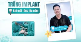 implant mất răng lâu năm