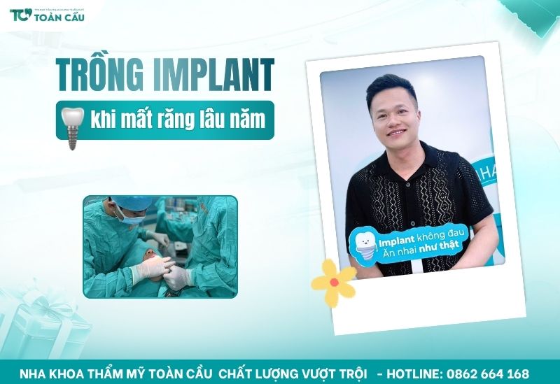 implant mất răng lâu năm