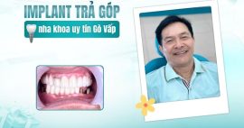 Implant nha khoa