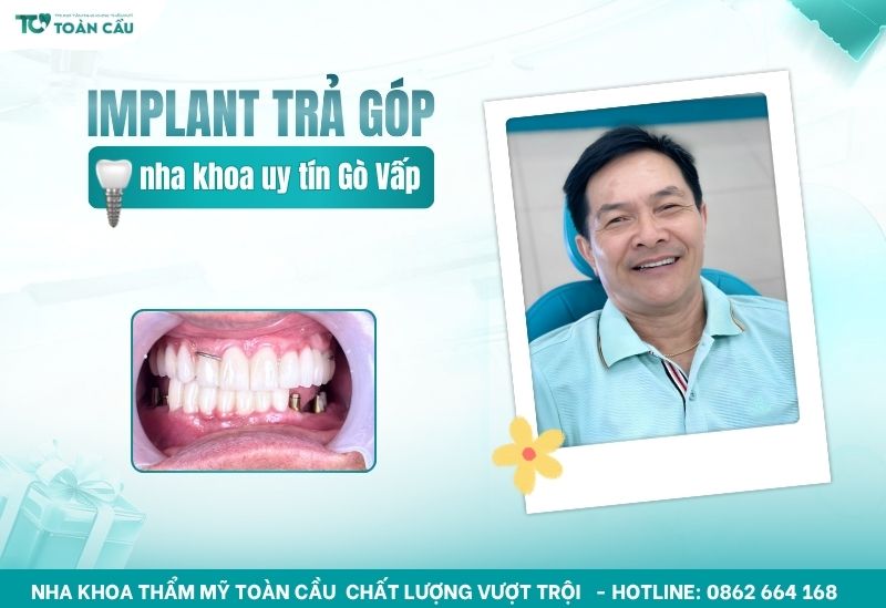 Implant nha khoa