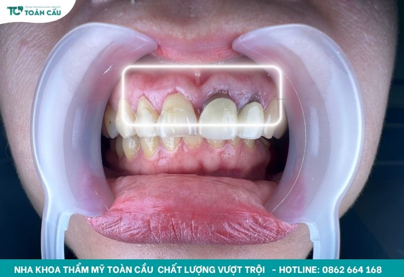 Cắt nướu thẩm mỹ bằng Laser