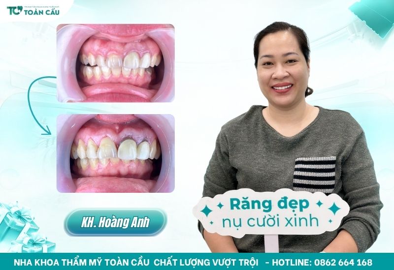 Ảnh Before - After từ khách hàng đã điều trị