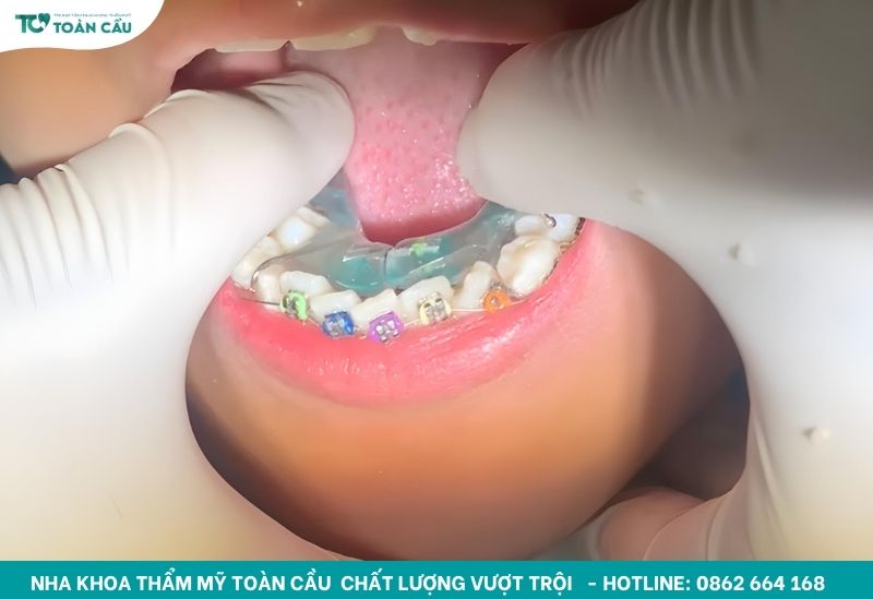 Niềng răng là kỹ thuật nha khoa phức tạp