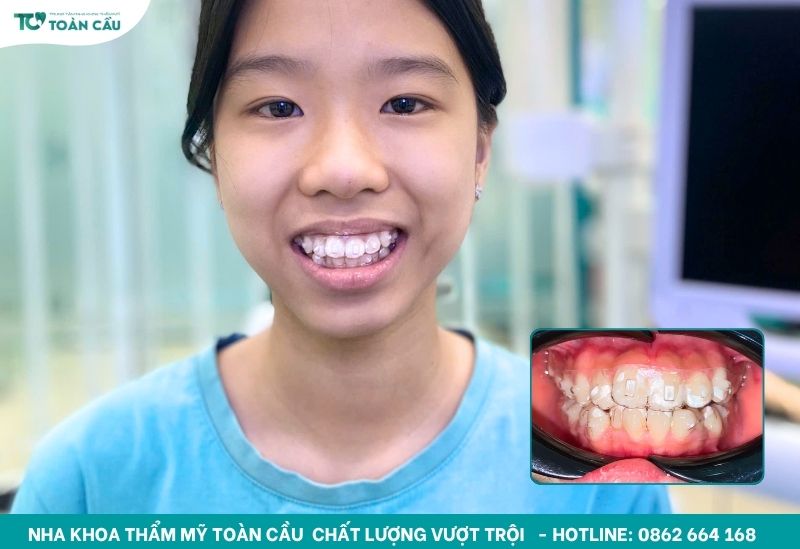 Niềng răng giá bao nhiêu tiền? Giá niềng 2025 6 Niềng răng trong suốt rất thẩm mỹ