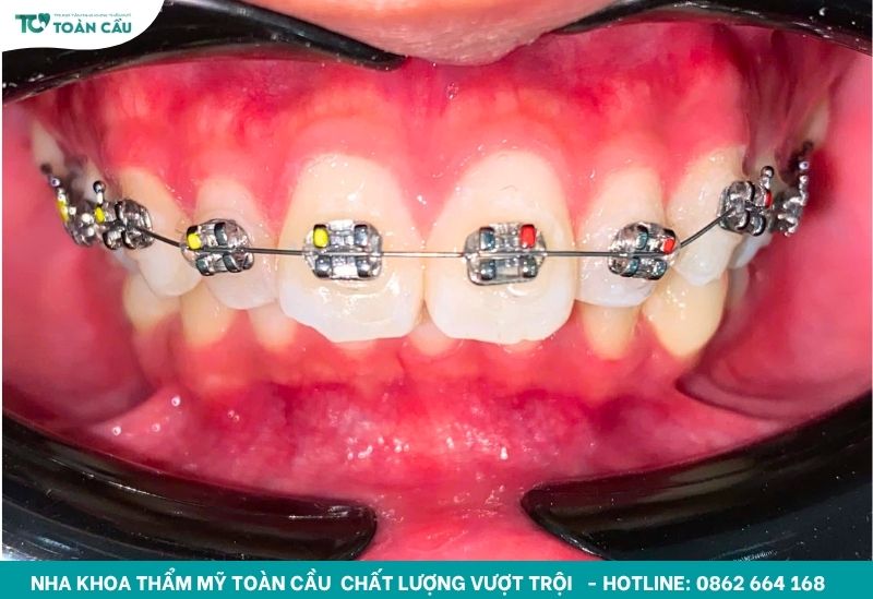 Niềng răng dịch chuyển răng về đúng vị trí