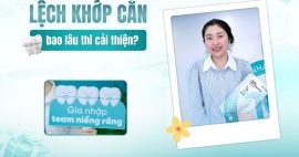 niềng răng lệch khớp cắn