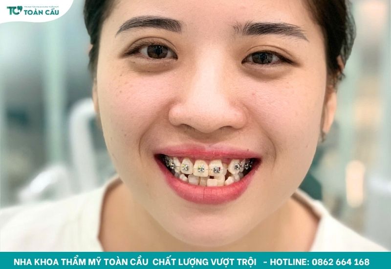 Niềng răng lệch khớp cắn bao lâu thì cải thiện rõ rệt 6 Niềng răng có thể cải thiện rõ rệt