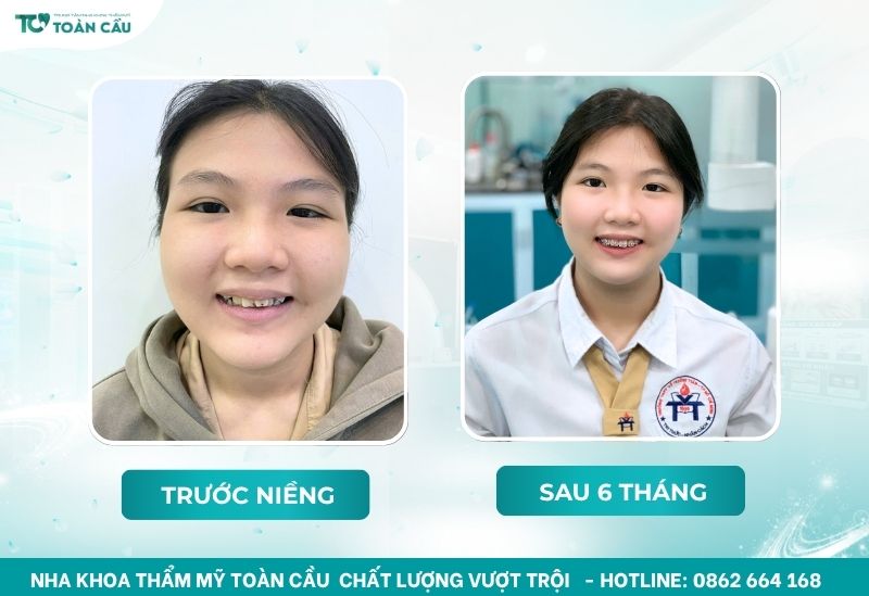 Niềng răng lệch khớp cắn bao lâu thì cải thiện rõ rệt 9 Khách hàng niềng răng tại Nha Khoa Thẩm Mỹ Toàn Cầu