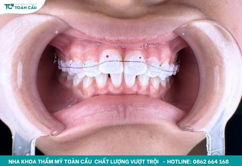 Niềng răng mắc cài sứ