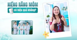 niềng răng móm ở đâu