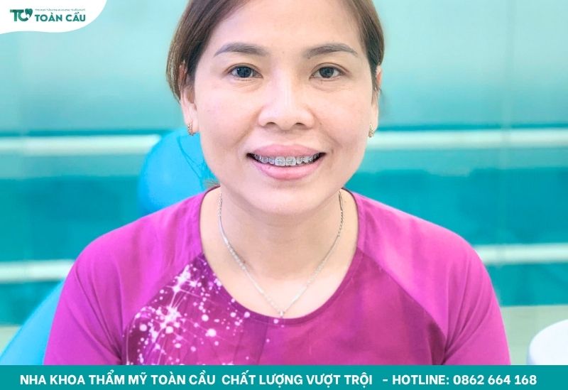Niềng răng ở tuổi trưởng thành