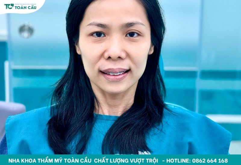 Khách hàng U40 niềng răng