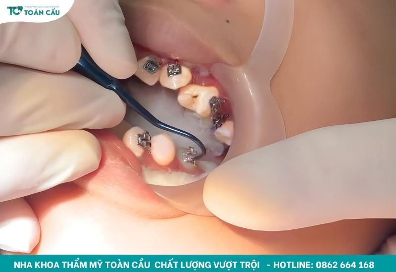 Địa chỉ niềng răng mắc cài chất lượng TPHCM