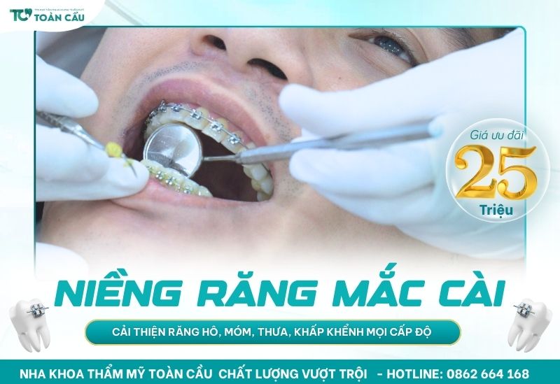 Niềng răng TPHCM trọn gói chỉ 25 triệu