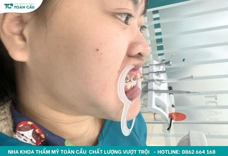 Niềng răng trọn gói tại Nha khoa Thẩm mỹ Toàn Cầu